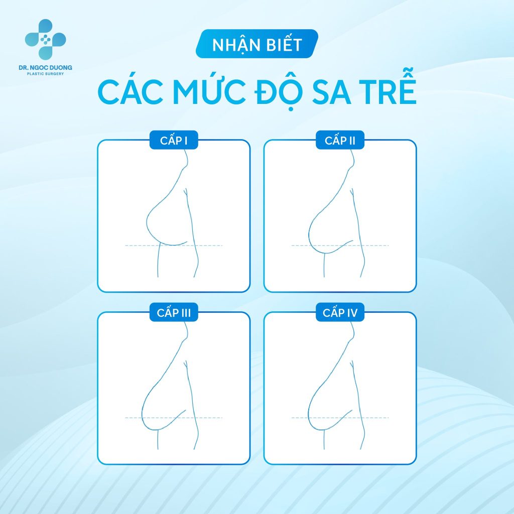các cấp độ sa trễ