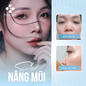 Hình ảnh khách hàng sau nâng mũi