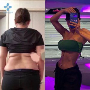  Hình trước và sau khách hàng hút mỡ
