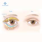 Cắt mắt tại Dr.Ngọc Dương