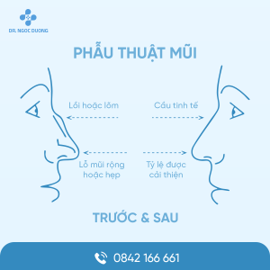 Nâng mũi - Ths.Bs nội trú Ngọc Dương